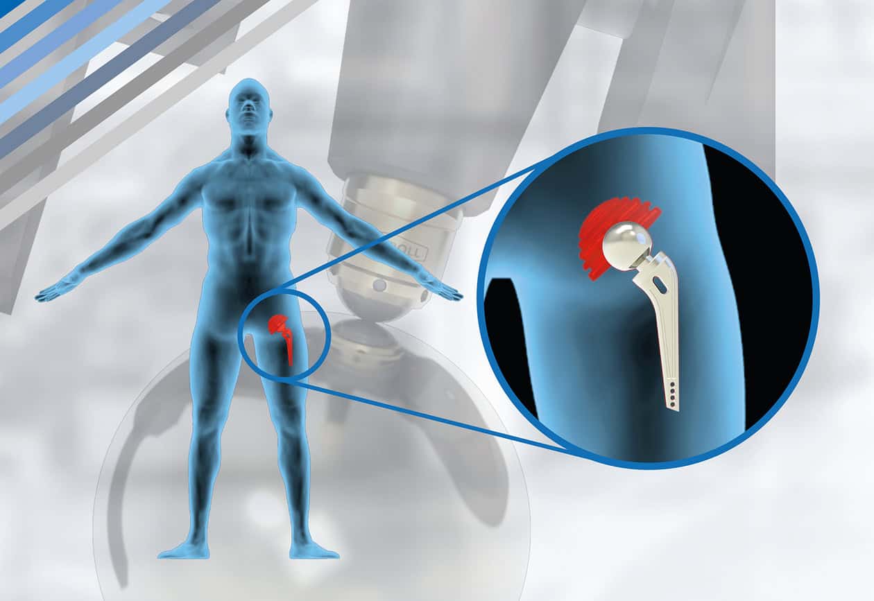 Protesi ossea all'anca